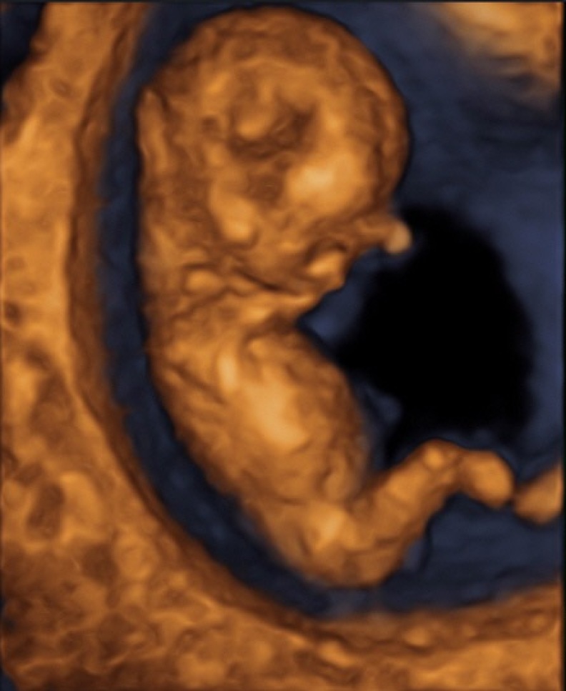 Embryo in der 13.Woche
